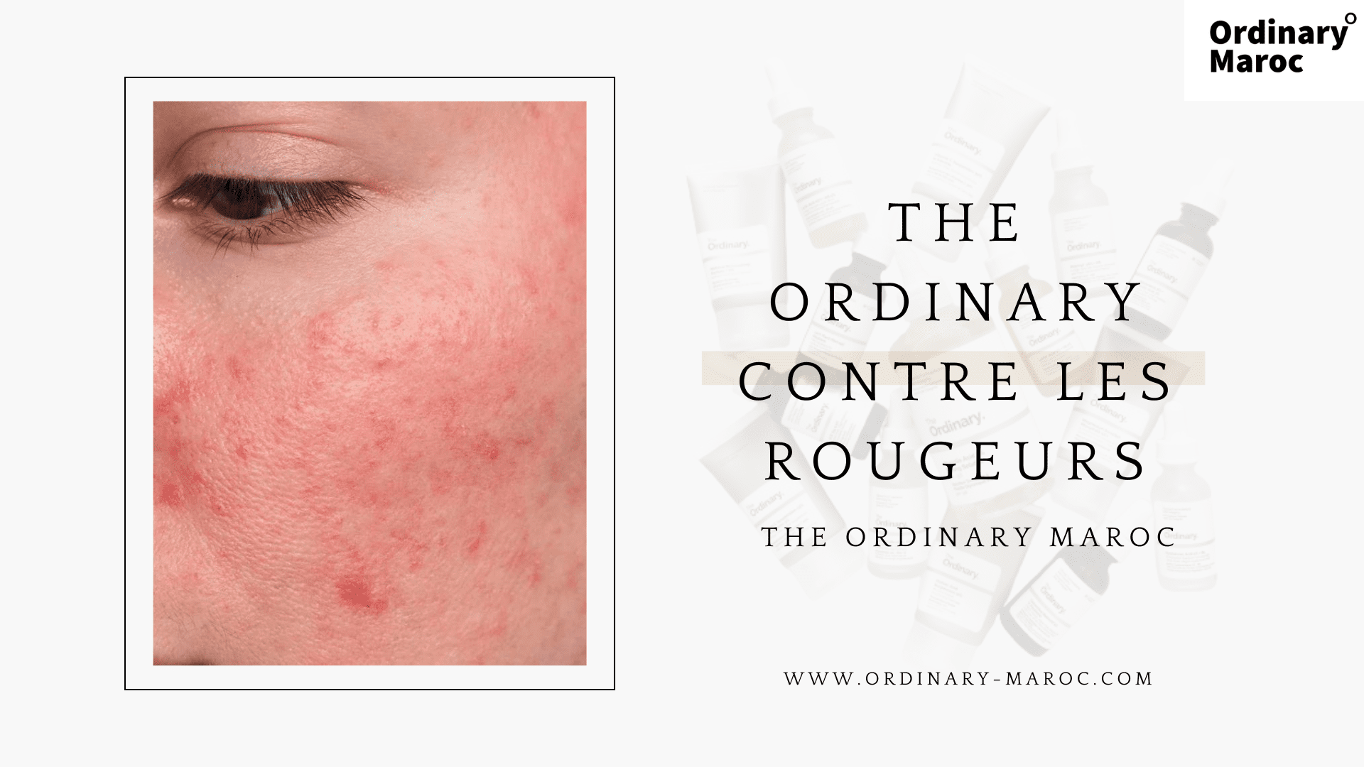 The Ordinary contre les Rougeurs